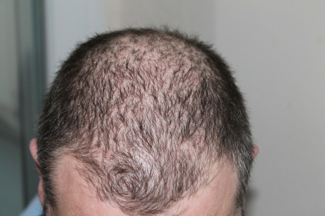 Causas y soluciones para la caída del cabello