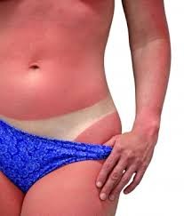 El Sol, ¿amigo o enemigo? Parte II. Riesgos potenciales de una exposición solar indebida
