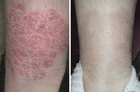 LA PSORIASIS, ¿PUEDE CONTROLARSE A TRAVÉS DE LA DIETA